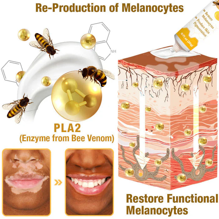 BEE VENOM VITILIGO TREATMENT CREAM