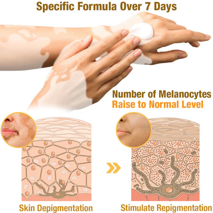 BEE VENOM VITILIGO TREATMENT CREAM