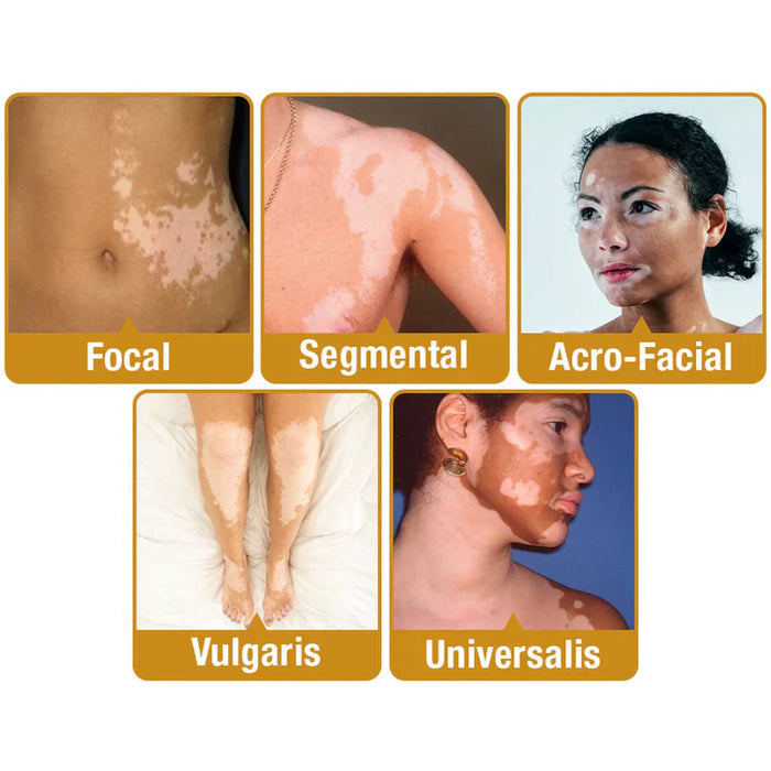 BEE VENOM VITILIGO TREATMENT CREAM