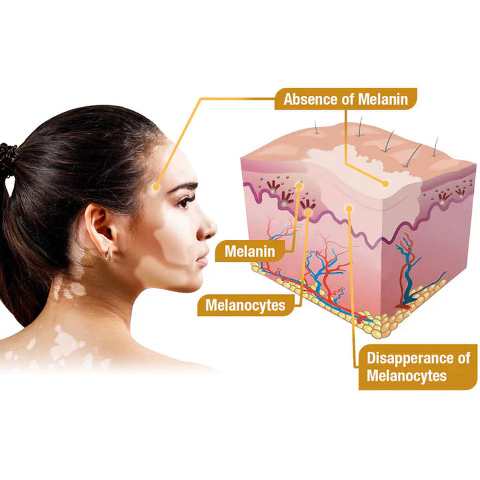 BEE VENOM VITILIGO TREATMENT CREAM