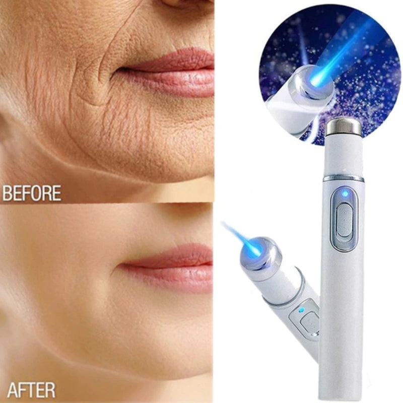 Acne Wrinkle Removal Laser Pen Skin