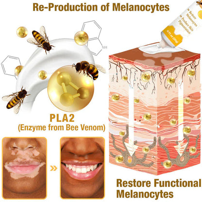 BEE VENOM VITILIGO TREATMENT CREAM