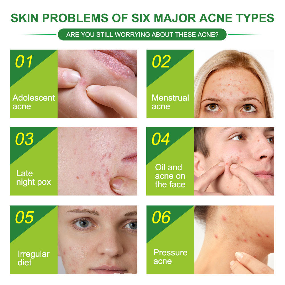 Pimple Patch: Hydrocolloid Acne Treatment